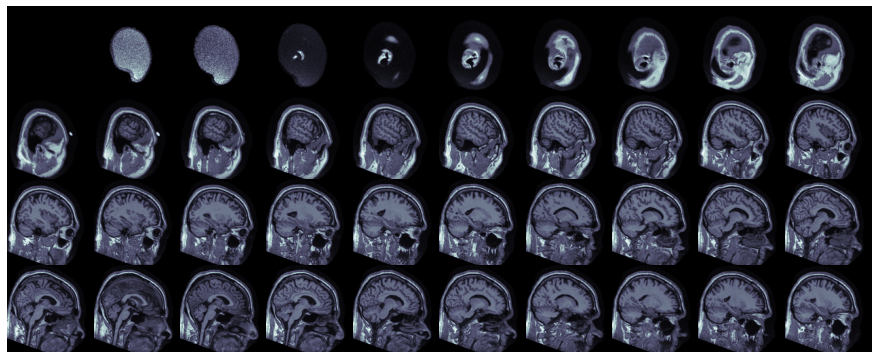 Weakly Supervised Alzheimer's Disease Detection from 3D MRI Scans